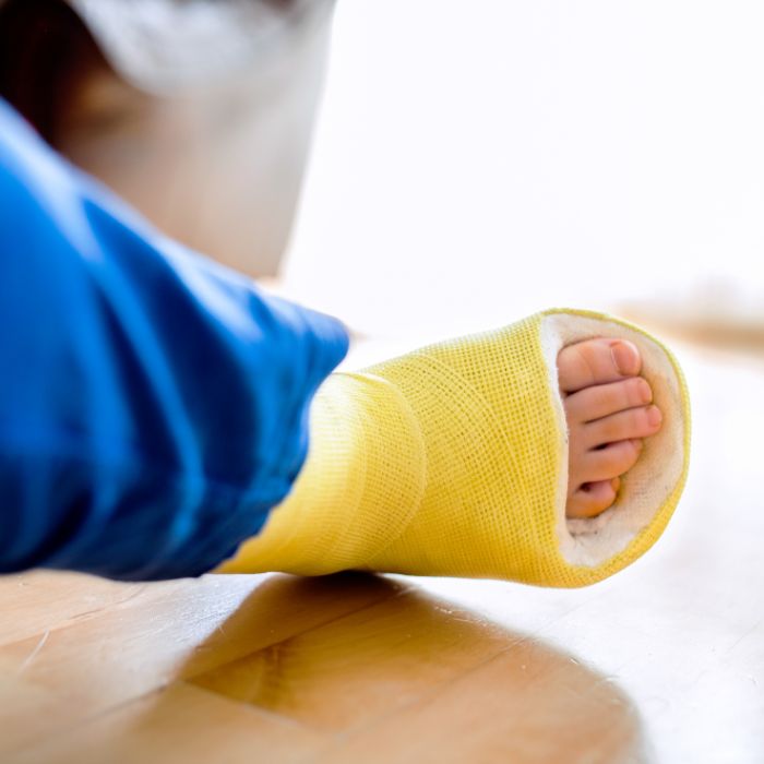 A close-up view of a child's foot in a bright yellow cast, highlighting interventions like serial casting taught in Progressive GaitWays' Pediatric Equinus Deformity online course.